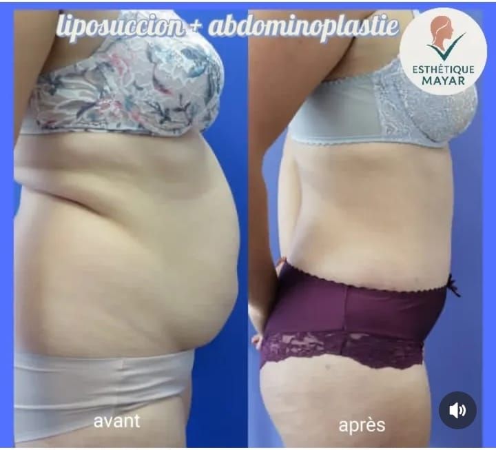 Liposuccion