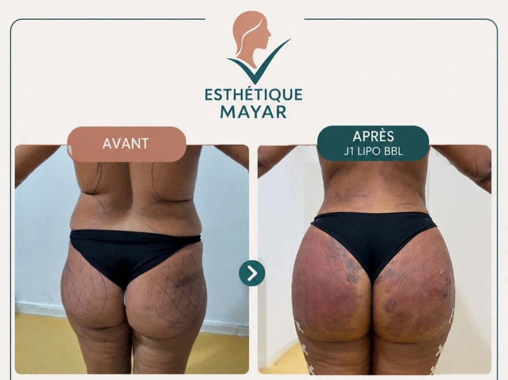 Lipo BBL : avant et après à J1, vue de dos