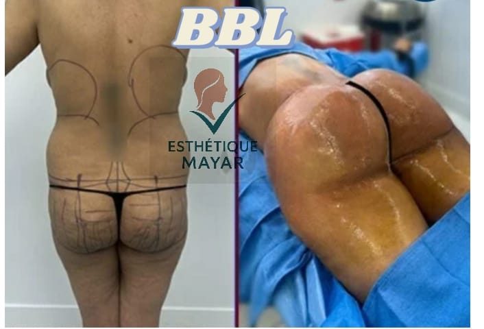 BBL : avant et après, vues de dos et de profil
