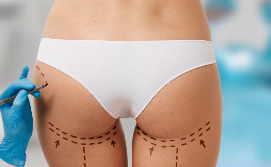 Tracé des zones de réinjection sur les fesses