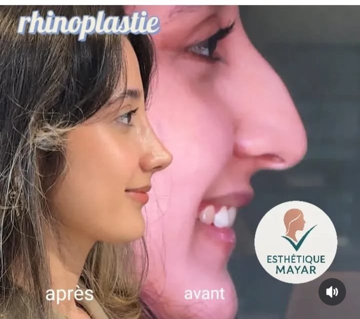 Rhinoplastie : profil avant et après