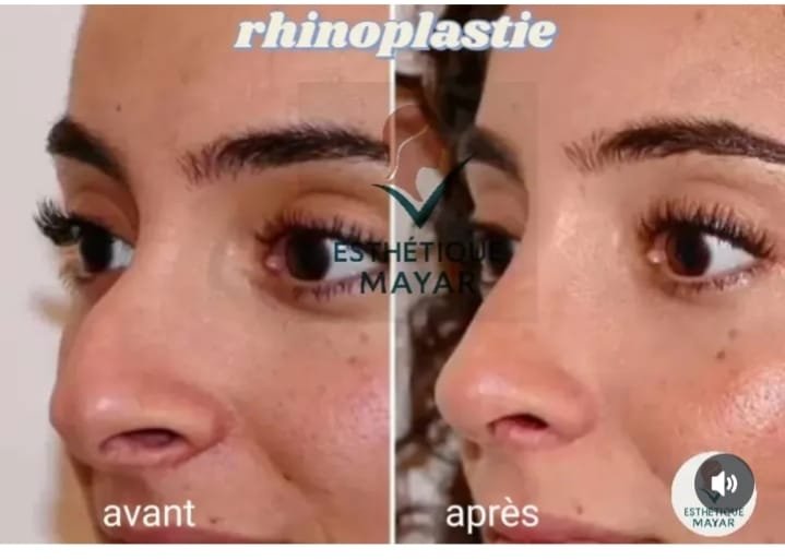 Rhinoplastie : vue de trois-quarts avant et après